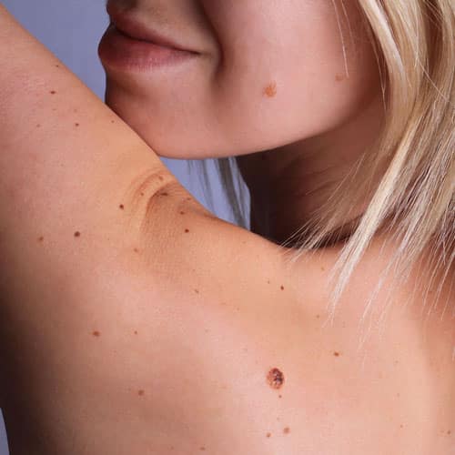 Birthmark Removal Before & After Pictures