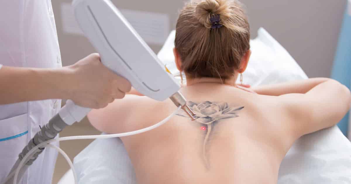 No Regrets Tattoo Removal  Laser Tattoo Removal based in Wizard Tattoo  Studio on Victoria Road Scarborough