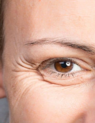 Laser Wrinkles Removal Before & After Pictures