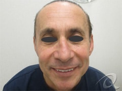 Botox Before & After Photos