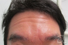 Botox & Fillers Before & After Photos