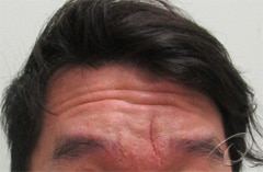 Botox & Fillers Before & After Photos