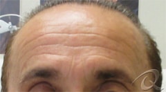 Botox Before & After Photos