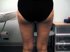 Cellulite Treatment Before After Photos