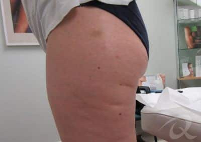 Cellulite Treatment Before After Photos