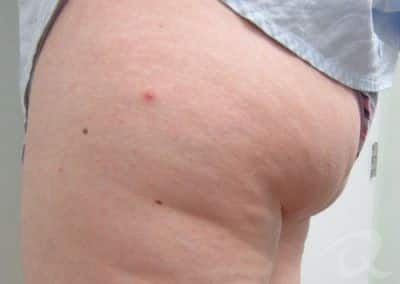 Cellulite Treatment Before After Photos