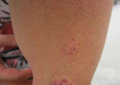 Birthmark Treatment Before & After Photos