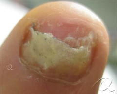 fungal-nail-treatment