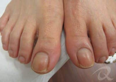 Fungal Nail Treatment Before & After Picture aa1