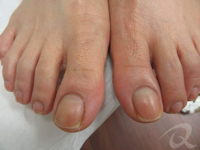 Fungal nail before after pictures|before after photos of nail fungus  treatment