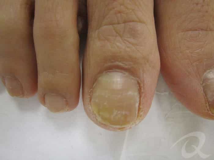 Fungal nail before after pictures|before after photos of nail fungus  treatment