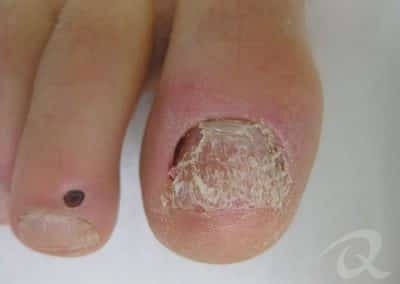 fungal-nail-treatment