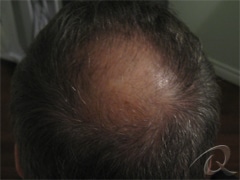Hair Loss Before & After Photos