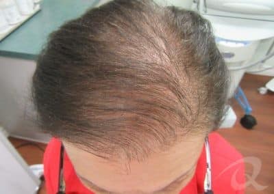Hair Loss Before & After Photos