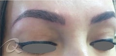 Permanent Makeup Removal Before After Photos