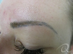 Permanent Makeup Removal Before After Photos