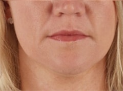 PRP Treatment Before & After Photos