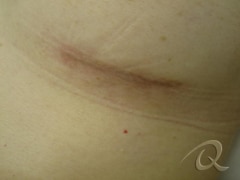 Scar Removal Before After Photos