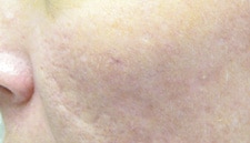 Scar Removal Before After Photos