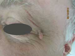 Skin Tag Before & After Photos