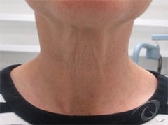 Skin Tightening Before & After Photos
