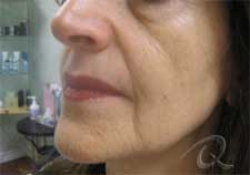 Skin tightening before after photo bb4