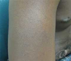 Tattoo Removal Before & After Photos