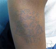 Tattoo Removal Before/After Photos