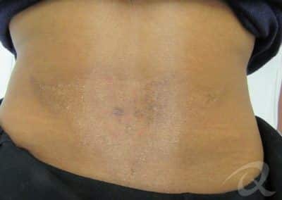 Tattoo Removal Before & After Photos