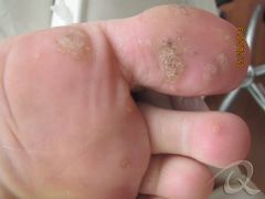 Wart Removal Before & After