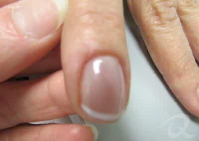 Wart Removal Before & After Photos