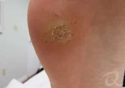 Wart Removal Before & After Photos