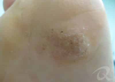 Wart Removal Before & After Photos
