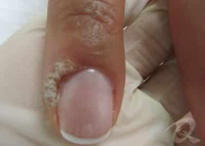 Wart Removal Before & After Photos
