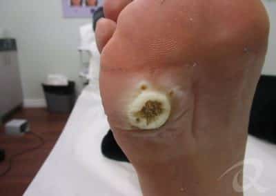 Wart Removal Before & After Photos