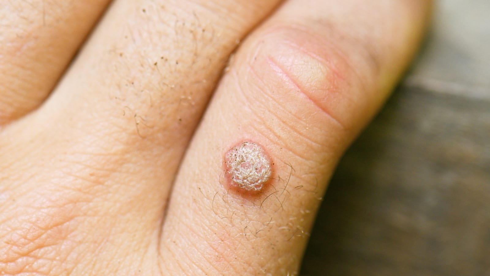 wart treatment toronto