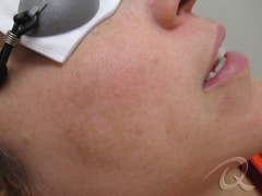 Age Spots Removal Before & After Photos