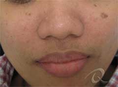 Age Spots Removal Before & After Photos