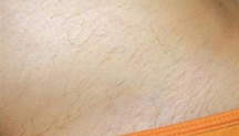 Laser Hair Removal Before & After Photos