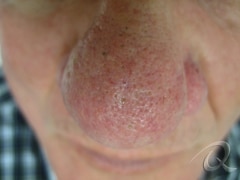 Rosacea Before & After Photos