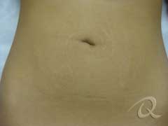Stretch Mark Removal Before After Photos