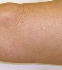 Vascular Vein Removal Before & After Photos