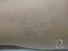 Vascular Vein Removal Before & After Photos