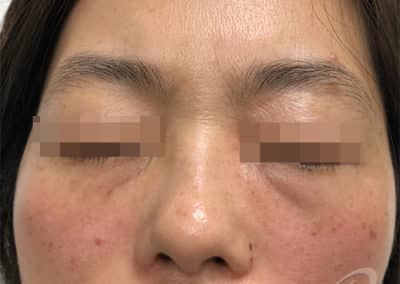 Dark circle eyes before after pictures