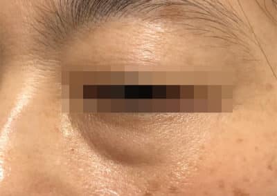 Dark circle eyes before after pictures