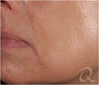 Wrinkles Removal Before After Pictures