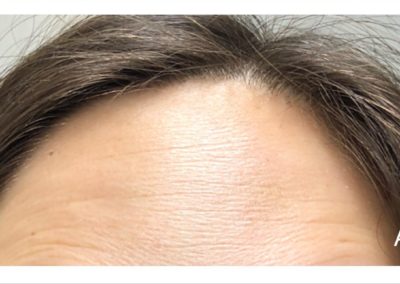 After forehead injection - dysport