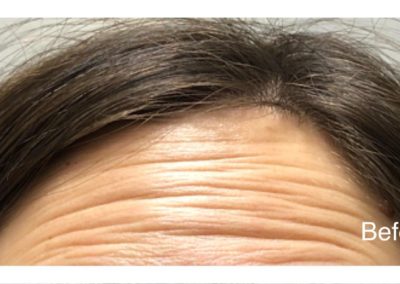 Before forehead injection - dysport