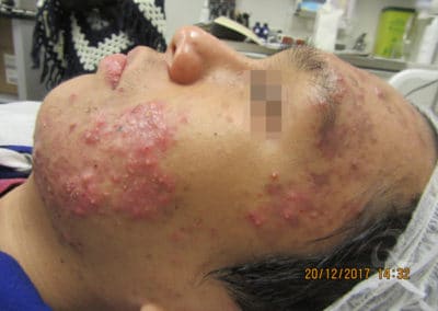 Acne before after pictures