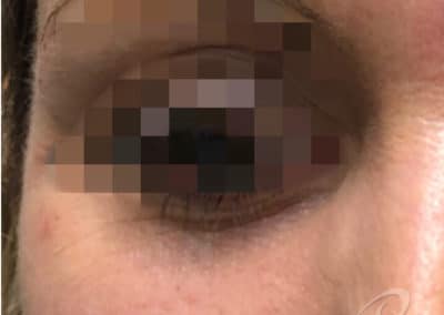 Dark Circle Eye Before After Photo